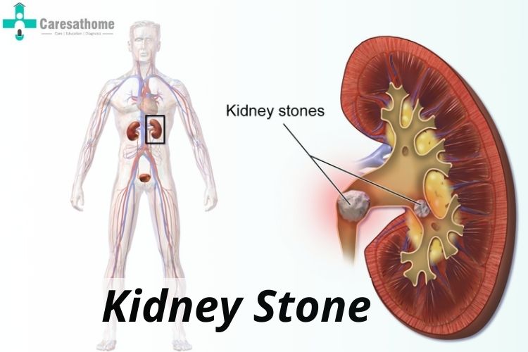 kidney stone pain chart