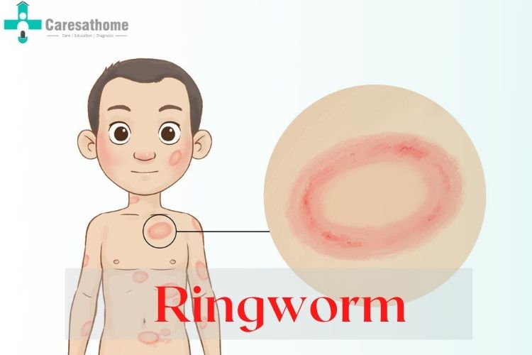 ringworm rash on stomach