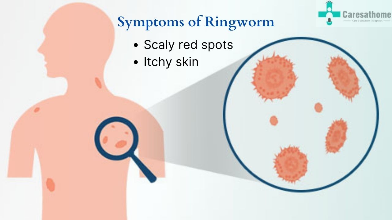 Tinea Corporis (Body Ringworm): Treatment and More
