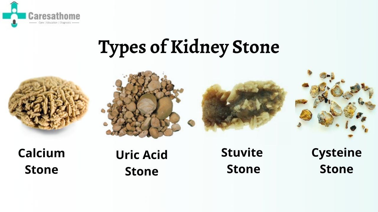 Kidney Stone Chart