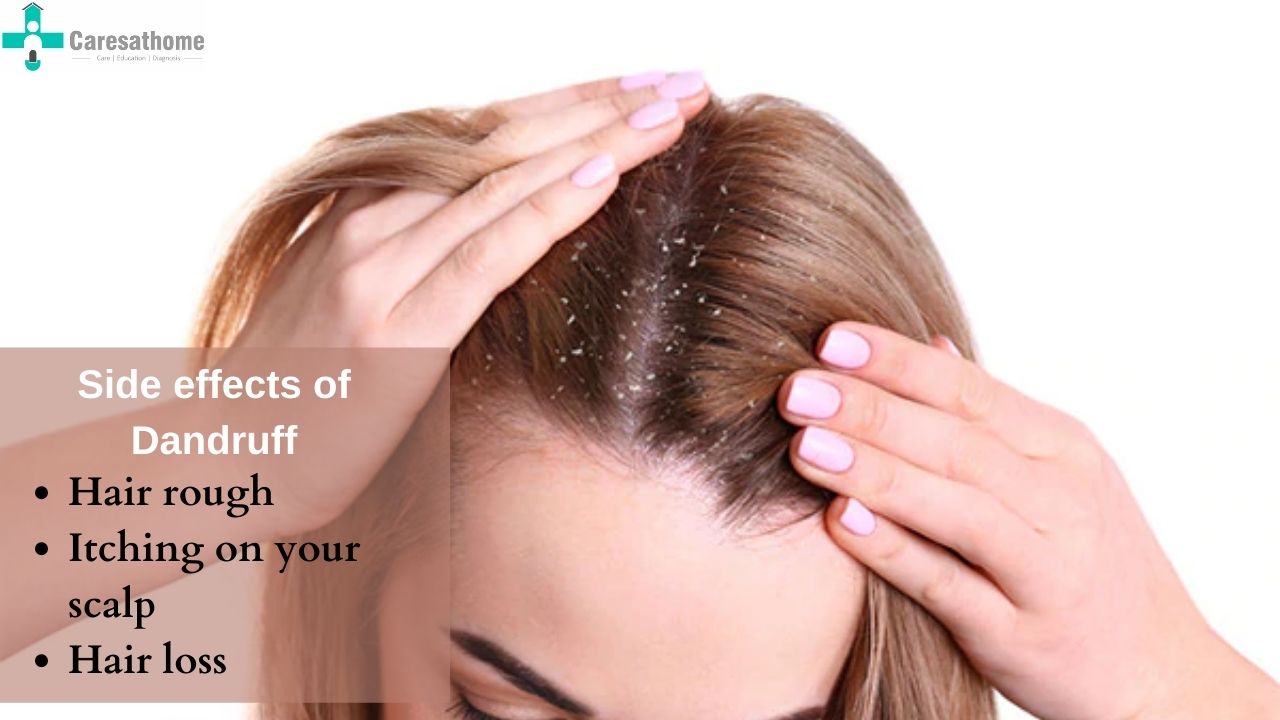 How Dandruff Effects Your Face  By Dr Dhananjay Chavan  Lybrate